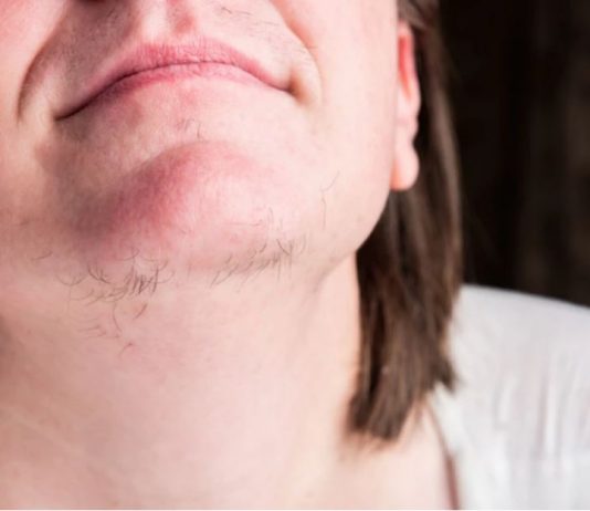 Kako ukloniti dlake sa lica na prirodan i jednostavan način: Epilacija kod kuće!