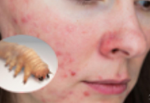 Doktorka joj pregledala lice dermoskopom, pronašla PARAZITA koji joj je UNIŠTAVAO LICE – Oprez, ovo je bolest koja se lako prenosi