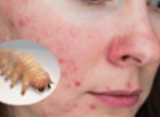 Doktorka joj pregledala lice dermoskopom, pronašla PARAZITA koji joj je UNIŠTAVAO LICE – Oprez, ovo je bolest koja se lako prenosi