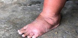 NAJVAŽNIJI vitamin za otklanjanje otoka ruku, nogu i stopala!