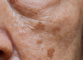 Prvi simptom MASNE JETRE vidi se na LICU obolelog – Znojenje i loš dah se najlakše prepoznaju, ali ove SIGNALE tela mnogi zanemare