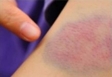 Najraniji Znakovi da Jetra Otkazuje: Prepoznajte Upozorenja