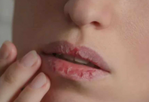 Nedostatak željeza u krvi: 6 neobičnih simptoma koji mogu ukazivati na anemiju