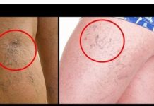 Svatko kod kuće ima lijek za popucale kapilare, ali mnogi ljudi to ne znaju!