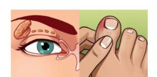 VISOK HOLESTEROL JE TIHI UBICA ČIJE SIMPTOME IGNORIŠE 96% LJUDI. Ovi simptomi će vam spasiti život. br. 4 je posljednje upozorenje