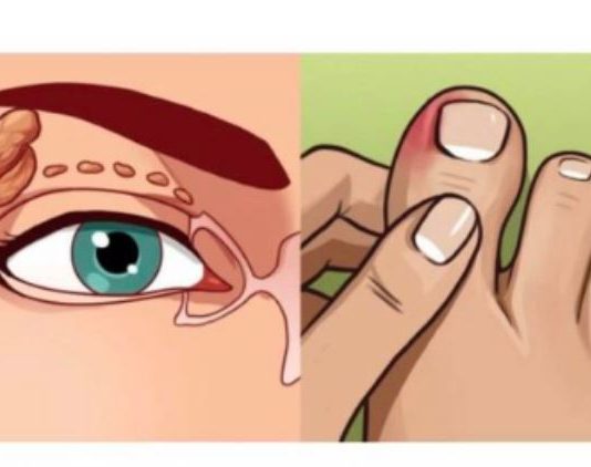 VISOK HOLESTEROL JE TIHI UBICA ČIJE SIMPTOME IGNORIŠE 96% LJUDI. Ovi simptomi će vam spasiti život. br. 4 je posljednje upozorenje