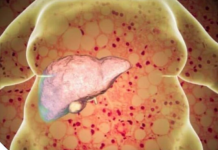 Jetra je prepuna toksina a vi se debljate:Recept koji samo za 72 sata u potpunosti očistite jetru