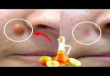 JABUČNI 0CAT uklanja BRADAV1CE za 24 SATA! Samo napravite ovo…