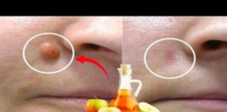 JABUČNI 0CAT uklanja BRADAV1CE za 24 SATA! Samo napravite ovo…