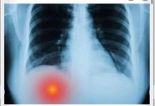 BOLI LI VAS ISPOD DESNOG REBRA? TO MOŽE BITI OZBILJAN PROBLEM: Većina ljudi nije svjesno da se BOLEST razvila do PRVE FAZE