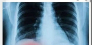 BOLI LI VAS ISPOD DESNOG REBRA? TO MOŽE BITI OZBILJAN PROBLEM: Većina ljudi nije svjesno da se BOLEST razvila do PRVE FAZE