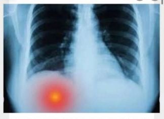 BOLI LI VAS ISPOD DESNOG REBRA? TO MOŽE BITI OZBILJAN PROBLEM: Većina ljudi nije svjesno da se BOLEST razvila do PRVE FAZE