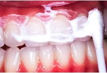 Držite ovu smjesu u ustima 60 sekundi i uklonit ćete vecinu kamenca sa zuba!