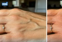 VENE SU VAM ISPUPČENE? 8 razloga zašto se to događa I KADA TREBATE POTRAŽITI DOKTORA!