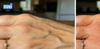 VENE SU VAM ISPUPČENE? 8 razloga zašto se to događa I KADA TREBATE POTRAŽITI DOKTORA!