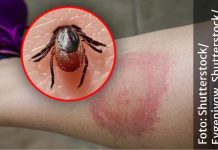 Muškarac je sam odmah uklonio krpelja, poslije nedjelju dana PAO JE U KOMU: Pojavili se jesenji krpelji, evo kako ih prepoznati Muškarac je sam odmah uklonio krpelja, poslije nedjelju dana PAO JE U KOMU: Niz analiza je bilo potrebno da se njegovo stanje poveže sa ubodom, ljekari porodici saopštili zastrašujuće činjenice - featured image